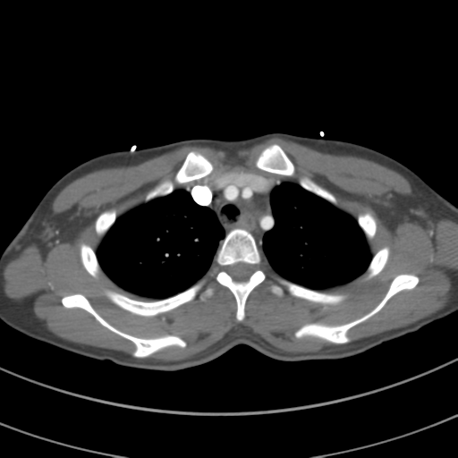 File:Abdominal multi-trauma - devascularised kidney and liver, spleen and pancreatic lacerations (Radiopaedia 34984-36486 Axial C+ arterial phase 21).png