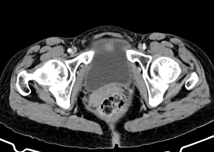 Abdominal wall and retroperitoneal tuberculosis (Radiopaedia 88137-104729 Axial C+ portal venous phase 186).jpg