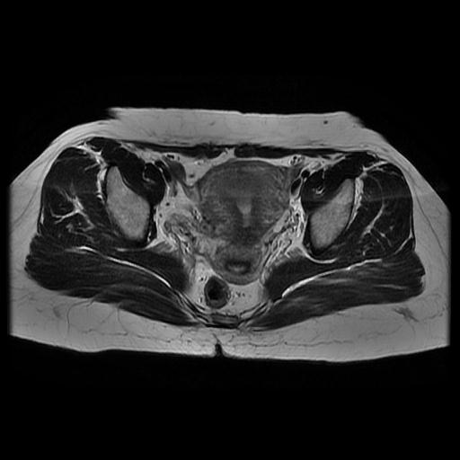 File:Abdominal wall endometriosis (Radiopaedia 83702-98847 Axial T2 10).jpg