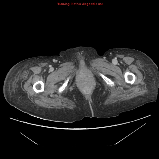 File:Abdominal wall hematoma (Radiopaedia 9427-10112 Axial C+ portal venous phase 117).jpg