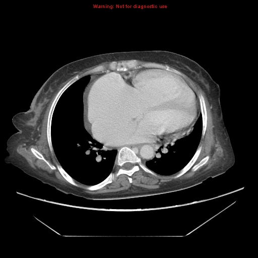 File:Abdominal wall hematoma (Radiopaedia 9427-10112 Axial C+ portal venous phase 3).jpg