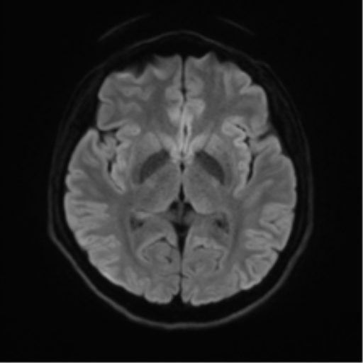 File:Abducens nerve palsy (Radiopaedia 51069-56648 Axial DWI 40).png