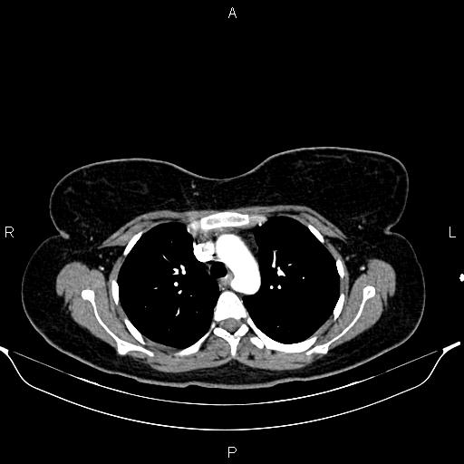 Aberrant right subclavian artery (Radiopaedia 87334-103629 Axial C+ arterial phase 23).jpg