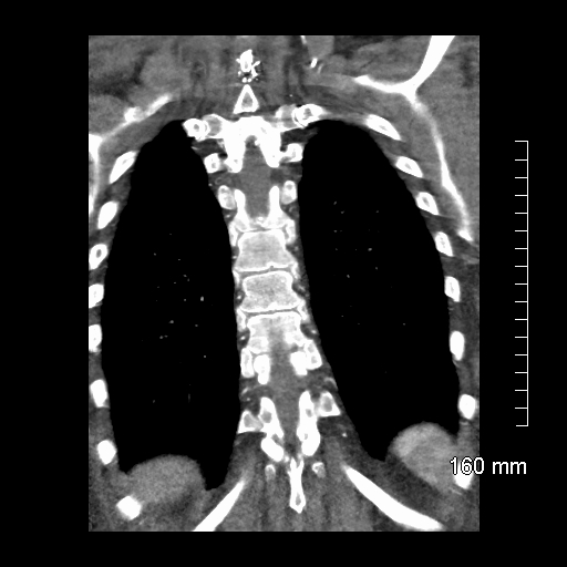Aberrant right subclavian artery stenosis (Radiopaedia 52656-58670 B 69).jpg