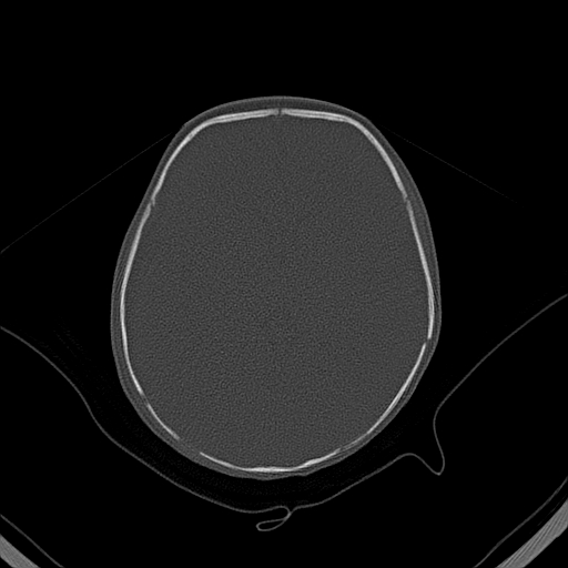 File:Accessory intraparietal suture (Radiopaedia 50584-56020 Axial bone window 23).jpg