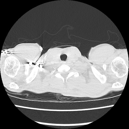 Accessory left horizontal fissure with lingular pneumonia (Radiopaedia 53763-59843 Axial lung window 1).jpg