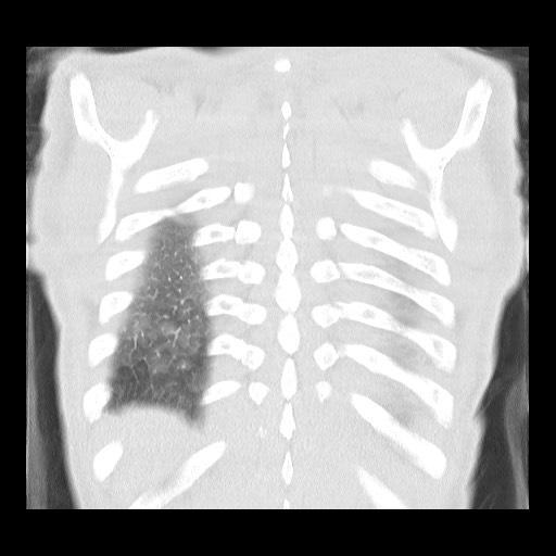 Accessory left horizontal fissure with lingular pneumonia (Radiopaedia 53763-59843 Coronal lung window 40).jpg