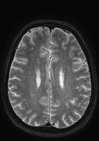 Accessory middle cerebral artery (Radiopaedia 73114-83828 Axial T2 11).jpg