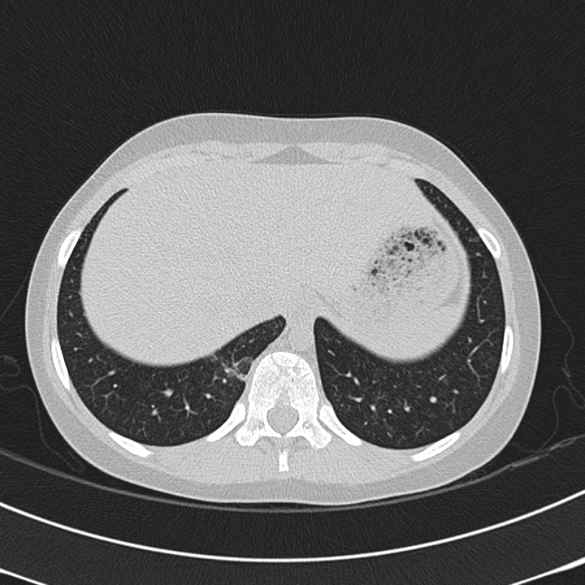 Achalasia (Radiopaedia 14946-14878 Axial lung window 71).jpg