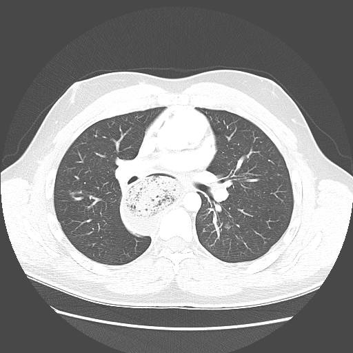 Achalasia (Radiopaedia 52507-58417 Axial lung window 29).jpg