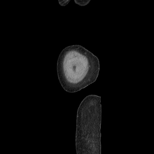 File:Acinar cell carcinoma of the pancreas (Radiopaedia 75442-86669 Sagittal C+ portal venous phase 190).jpg