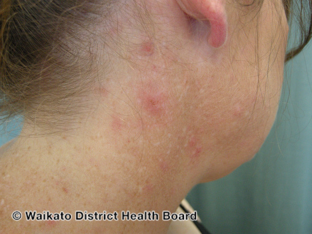 File:Acne urticata (DermNet NZ acne-w-acne-urticata-3).jpg