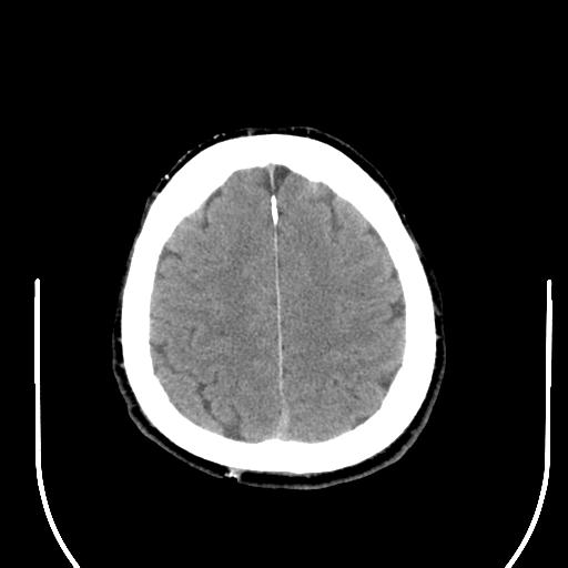 File:Acoustic schwannoma (Radiopaedia 29488-29982 AXIAL THICK non-contrast 40).jpg