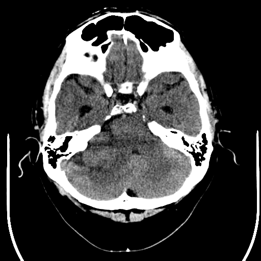 File:Acoustic schwannoma (Radiopaedia 39170-41389 Axial non-contrast 7).png