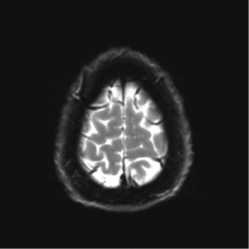 File:Acoustic schwannoma (Radiopaedia 50846-56358 Axial DWI 27).png