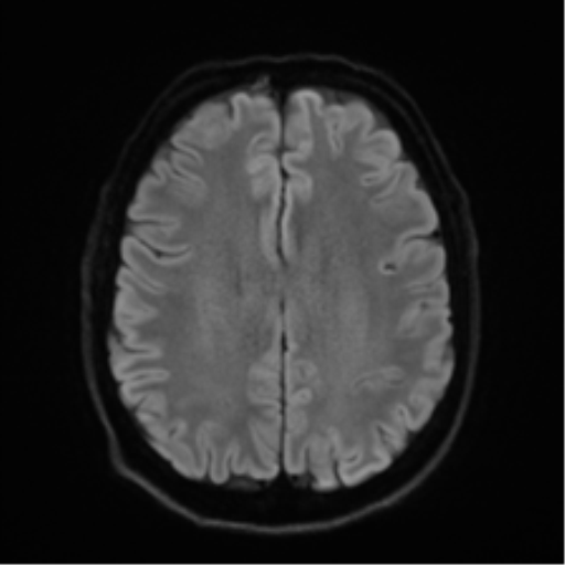 Acoustic schwannoma (Radiopaedia 50846-56358 Axial DWI 47).png