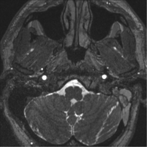 Acoustic schwannoma (translabyrinthine resection) (Radiopaedia 43570-46972 Axial CISS 7).png