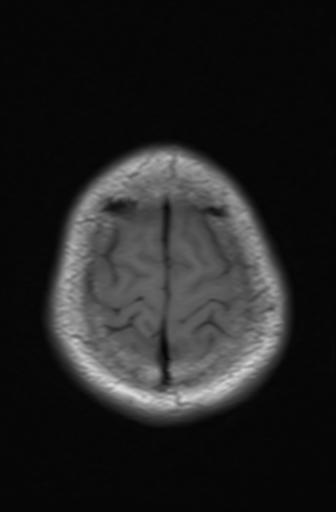 Acoustic schwannoma - probable (Radiopaedia 20386-20292 Axial T1 17).jpg