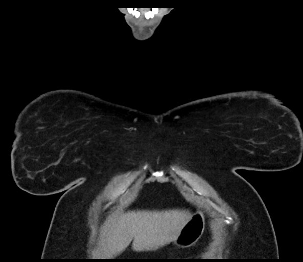 Acromioclavicular joint cyst (Radiopaedia 58455-65610 Coronal C+ arterial phase 22).jpg