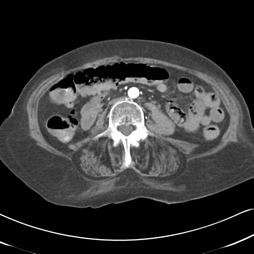 Active bleeding from duodenal ulcer with embolization (Radiopaedia 34216-35481 Axial C+ arterial phase 34).png