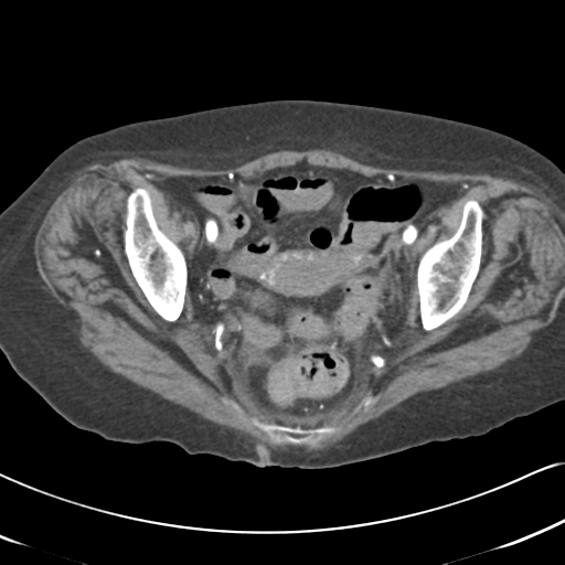 File:Active bleeding from duodenal ulcer with embolization (Radiopaedia 34216-35481 Axial C+ arterial phase 57).png