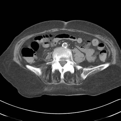 Active bleeding from duodenal ulcer with embolization (Radiopaedia 34216-35481 Axial non-contrast 39).png