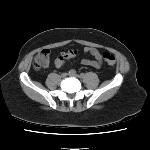 Active colonic bleed on CT (Radiopaedia 49765-55025 Axial non-contrast 57).jpg