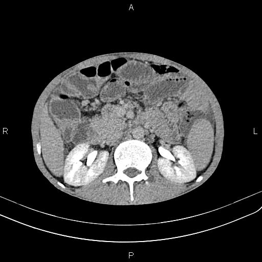 Active crohn disease (Radiopaedia 87133-103397 Axial C+ delayed 18).jpg
