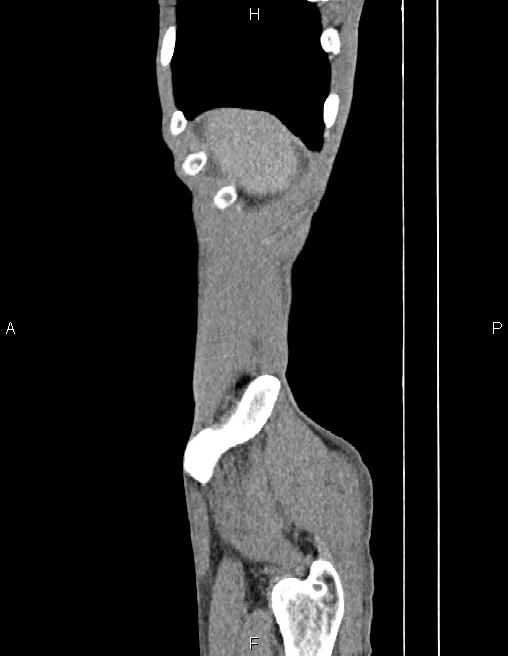 Active crohn disease (Radiopaedia 87133-103397 Sagittal C+ arterial phase 4).jpg