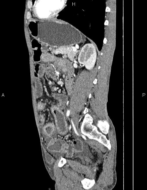 Active crohn disease (Radiopaedia 87133-103397 Sagittal C+ arterial phase 58).jpg