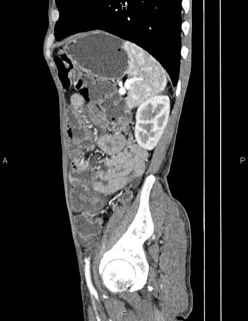 Active crohn disease (Radiopaedia 87133-103397 Sagittal C+ arterial phase 69).jpg
