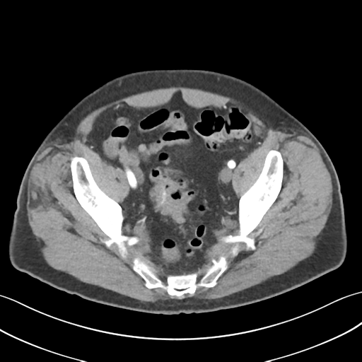 File:Active diverticular hemorrhage (Radiopaedia 39415-41725 Axial C+ arterial phase 57).png