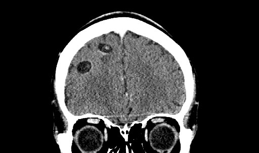 File:Active neurocysticercosis before and after therapy (Radiopaedia 71710-82099 Coronal C+ delayed 21).jpg