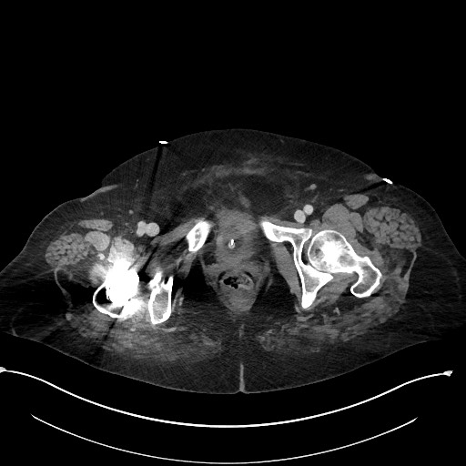 File:Active renal extravasation with large subcapsular and retroperitoneal hemorrhage (Radiopaedia 60975-68796 Axial 330).jpg