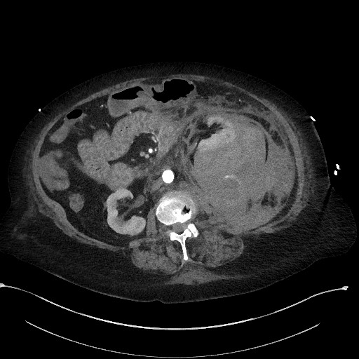 File:Active renal extravasation with large subcapsular and retroperitoneal hemorrhage (Radiopaedia 60975-68796 Axial C+ arterial phase 88).jpg