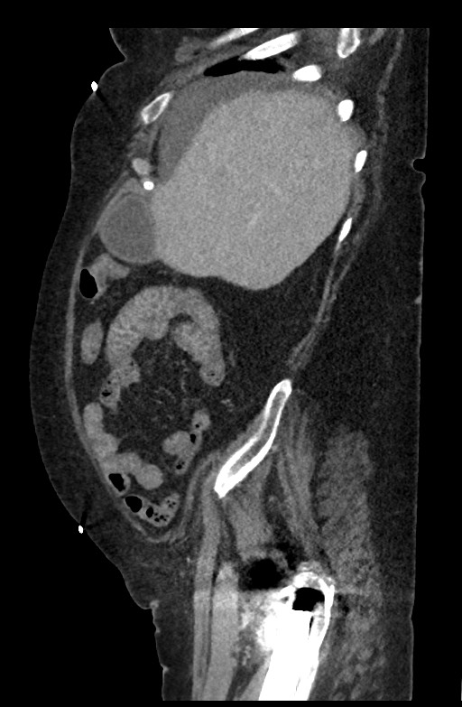Active renal extravasation with large subcapsular and retroperitoneal hemorrhage (Radiopaedia 60975-68796 Sagittal C+ portal venous phase 174).jpg
