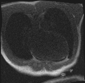 Active right ventricular cardiac sarcoidosis (Radiopaedia 55596-62100 Axial Dynamic perfusion scan MOCO 13).jpg