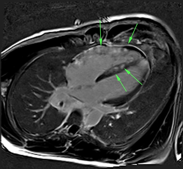 File:Active right ventricular cardiac sarcoidosis (Radiopaedia 55596-62103 4 CH PSIR 1).jpg