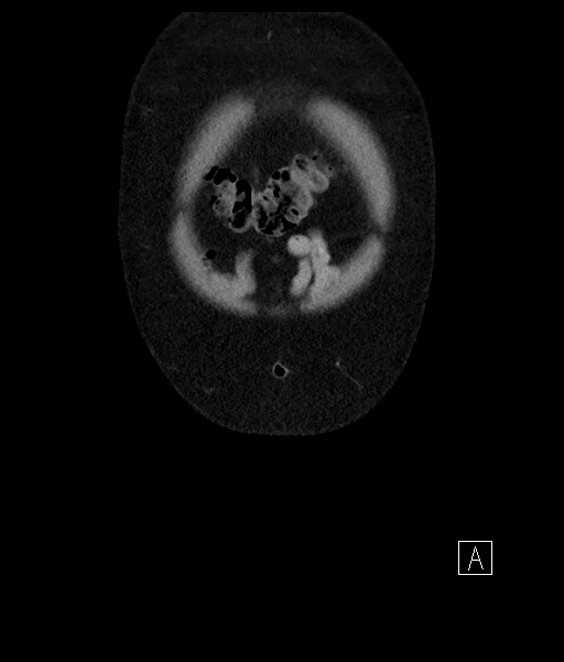 Acute-on-chronic pancreatitis (Radiopaedia 67286-76656 Coronal C+ portal venous phase 10).jpg