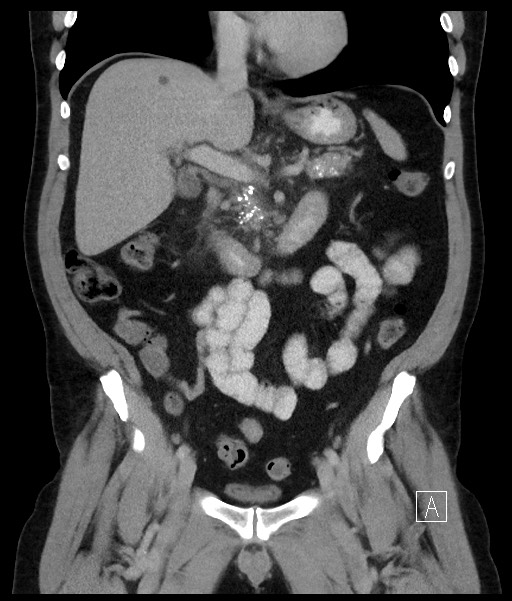 Acute-on-chronic pancreatitis (Radiopaedia 67286-76656 Coronal C+ portal venous phase 38).jpg