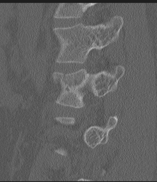 Acute L1 burst compression fracture (Radiopaedia 34430-35755 Sagittal bone window 20).png