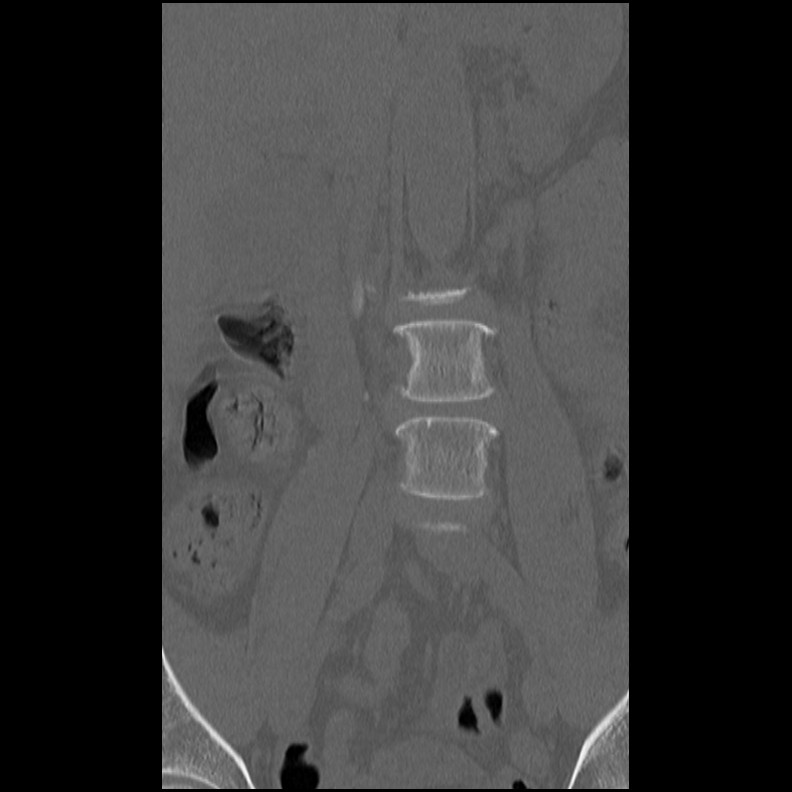 Acute Schmorl's node (Radiopaedia 83276-102365 Coronal bone window 14).jpg