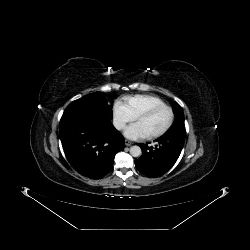 Acute appendicitis, heterotaxy syndrome (Radiopaedia 66884-76202 Axial C+ portal venous phase 7).jpg
