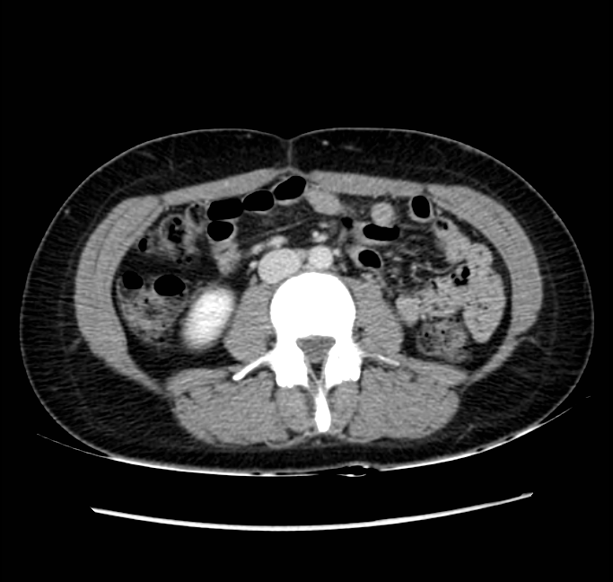 Acute appendicitis (Radiopaedia 22892-22918 Axial C+ portal venous phase 43).png