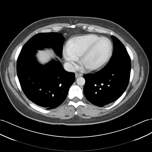 File:Acute appendicitis (Radiopaedia 30297-30934 Axial C+ portal venous phase 4).jpg