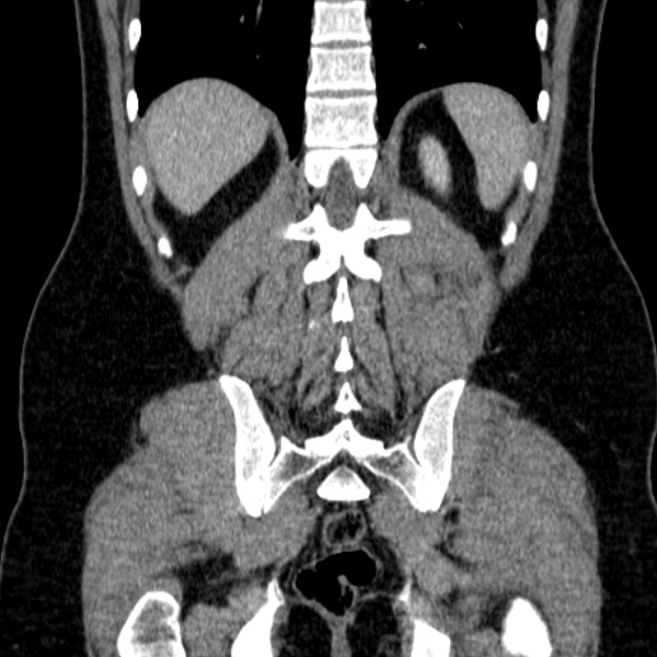 Acute appendicitis (Radiopaedia 38255-40270 Coronal C+ portal venous phase 68).jpg