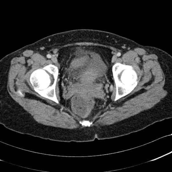 File:Acute appendicitis (Radiopaedia 48792-53822 Axial C+ portal venous phase 110).jpg