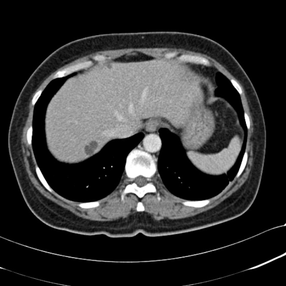 File:Acute appendicitis (Radiopaedia 48792-53822 Axial C+ portal venous phase 14).jpg