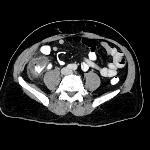 File:Acute appendicitis (Radiopaedia 77016-88960 Axial C+ portal venous phase 92).jpg