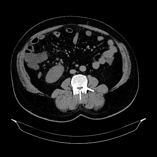 Acute appendicitis (Radiopaedia 79950-93224 Axial non-contrast 55).jpg